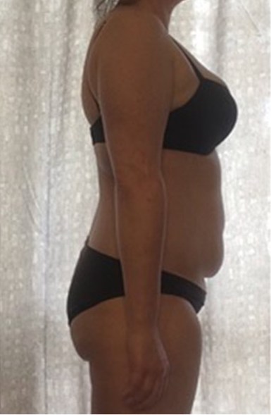 Carrie J – lost 6kg in 26 days on HCG diet NZ